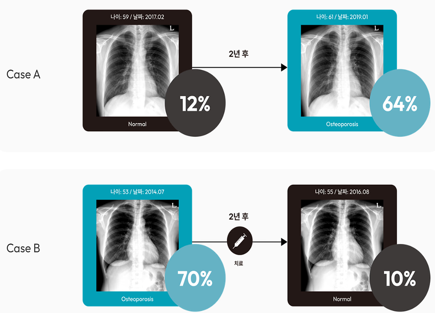 ▲ CRO(Chest Radiograph Osteoporosis) Score을 통한 환자 추적 관찰 (출처: 프로메디우스)